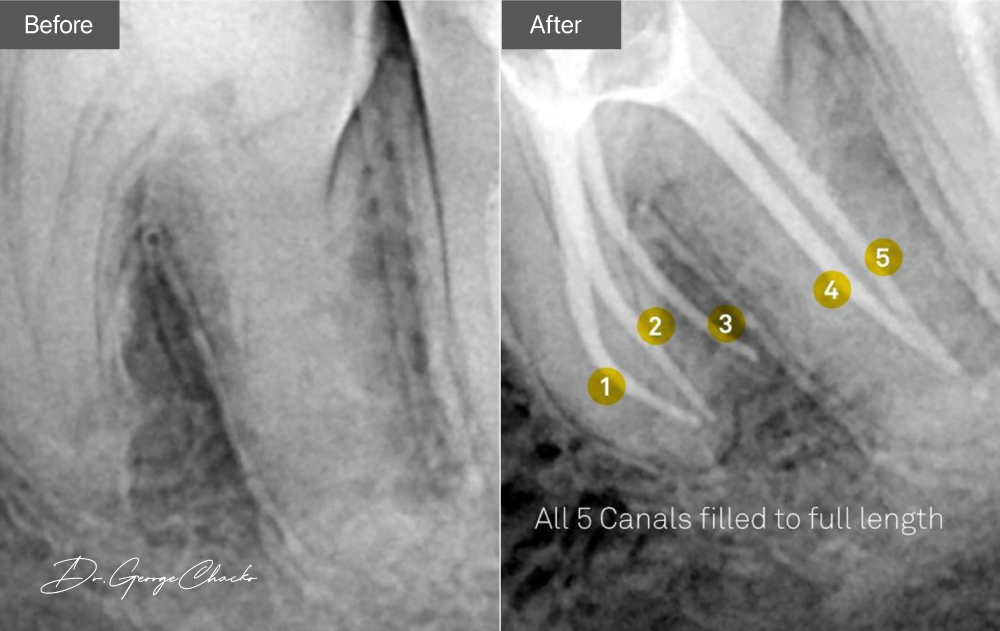 Root Canal Treatment Cost What to Expect ICDE UAE