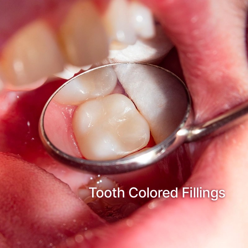 Dental Fillings in Abu Dhabi Experience LongLasting Results