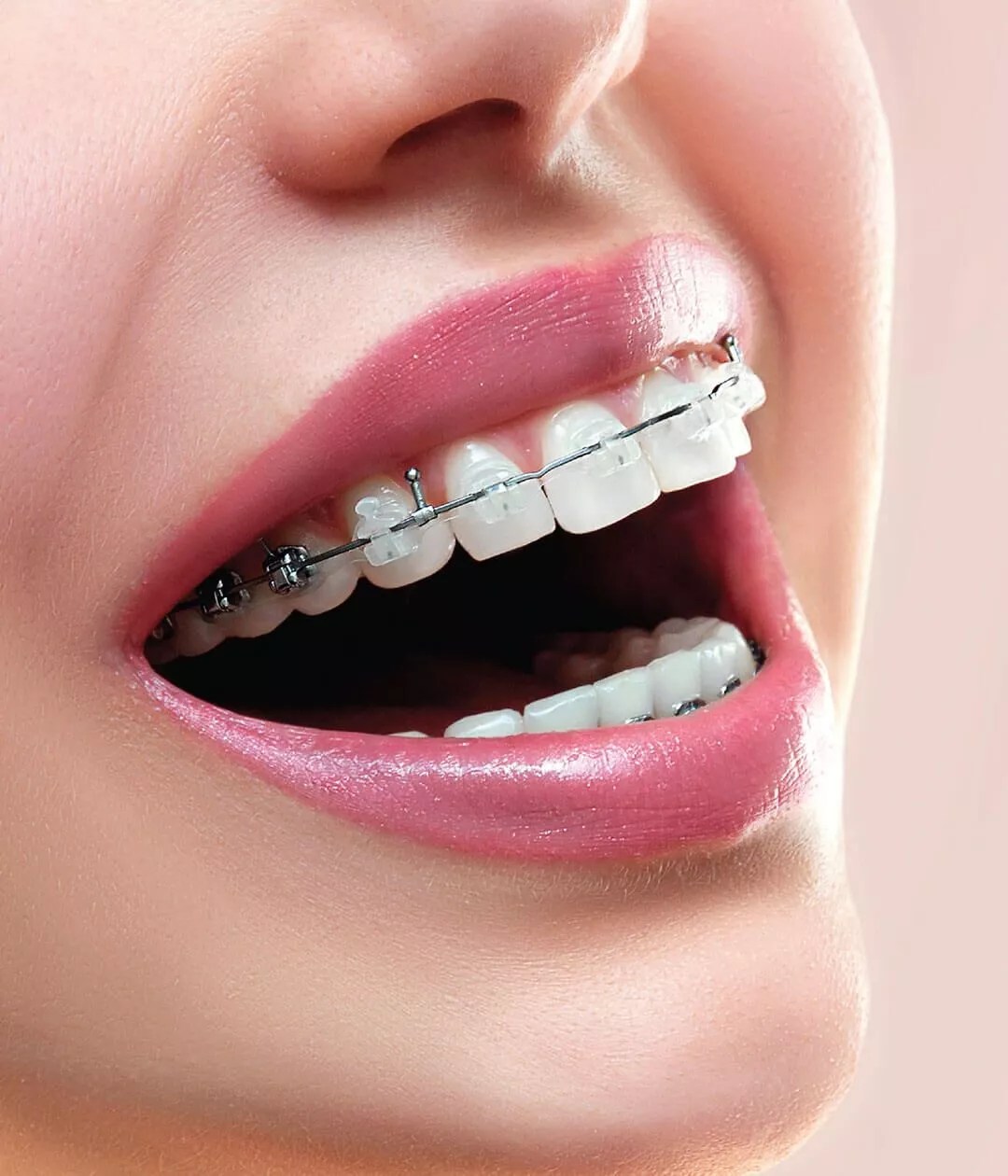 Discreet Straightening with Ceramic Braces ICDE UAE