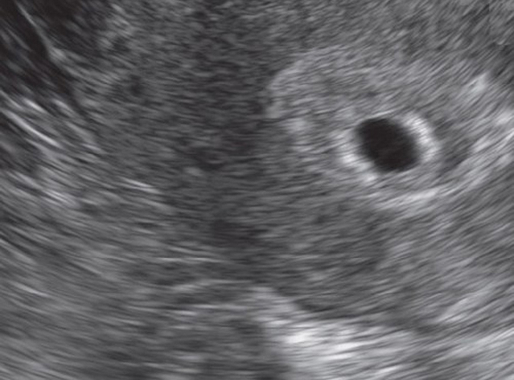 24+ schlau Bild Ab Wann Einnistung Alles Was Sie Uber