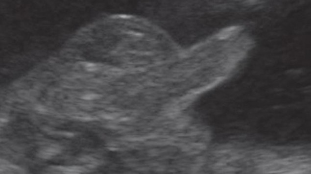 32 Ssw Ultraschall / Ultraschallbilder Schwangerschaft Ssw legen sie