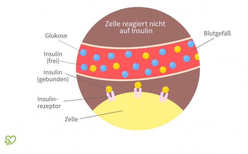 Diabetes mellitus Typ 2 Ursachen, Symptome, Behandlung Onmeda.de
