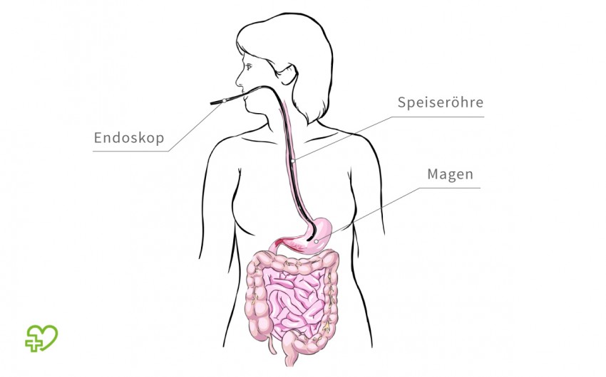 Gallenkolik Symptome, Behandlung, Medikamente Onmeda.de