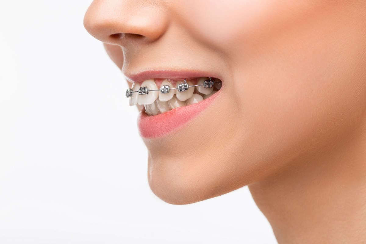 What Causes a Gummy Smile and How Can Orthodontic Treatment Help?