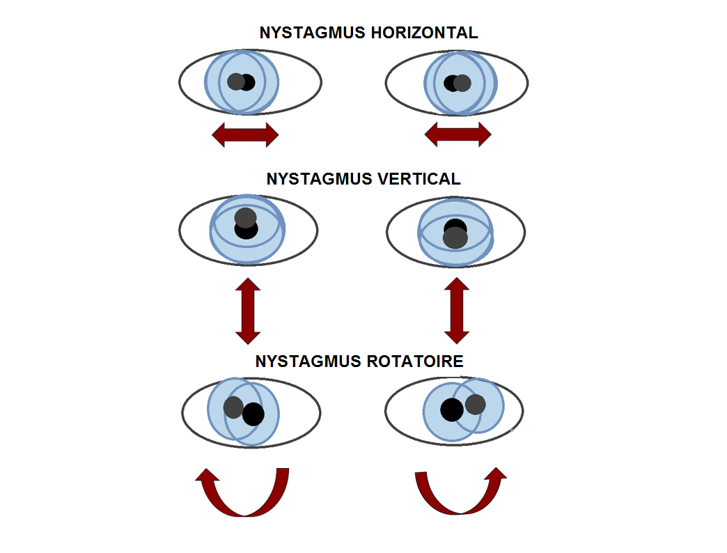 Le nystagmus Neuroophtalmologie Institut Català de Retina