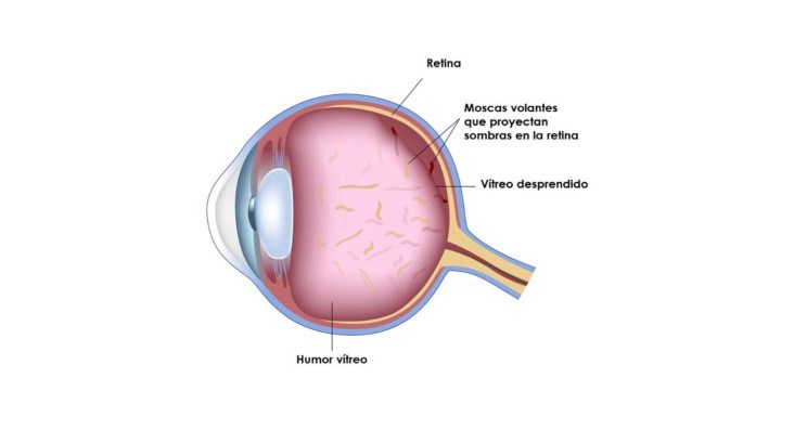 Desprendimiento de vítreo. Moscas flotantes y centelleos.