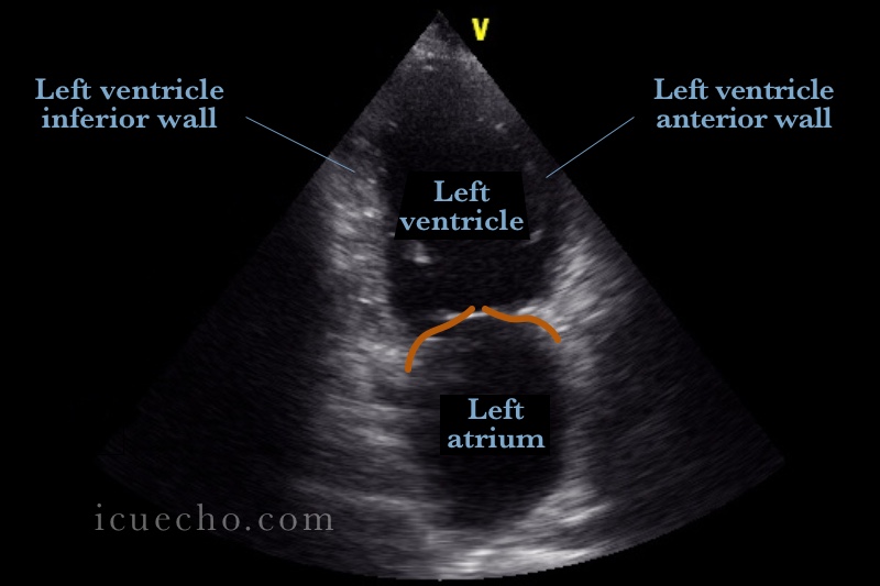 Apical 2 Chamber ICU & Echo