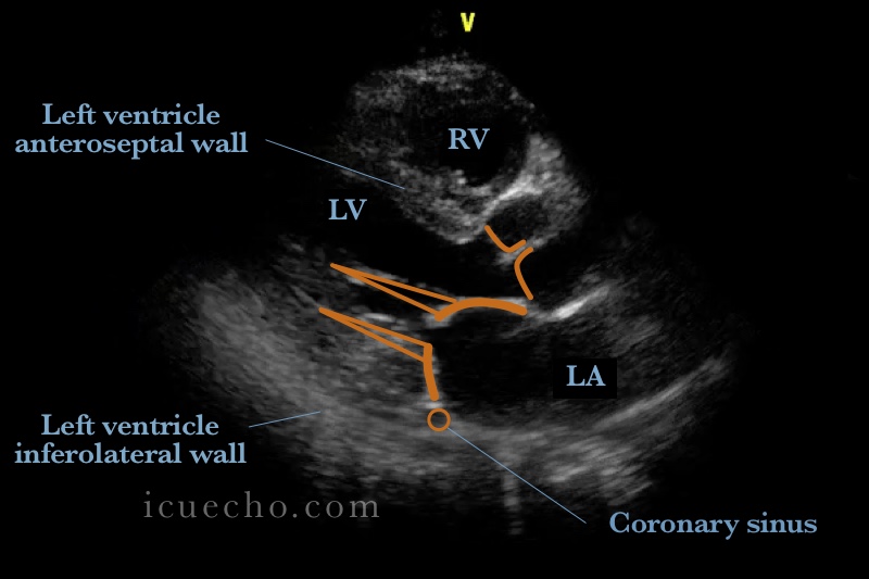 Parasternal long axis ICU & Echo