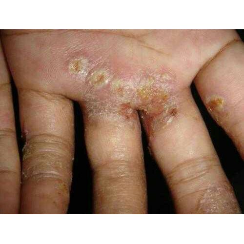 Cod Scabimite Cream 10g Gudik Dan Kudis Salep Gatal Kulit Salep Scabies Salep Tungau Bergaransi Lazada Indonesia