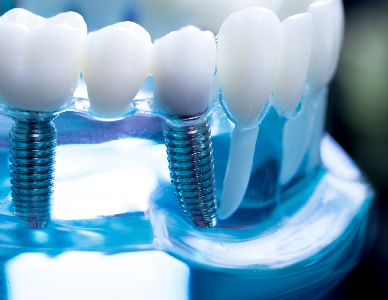 Dental Implant Market 3 Global Trends You Should Be Aware of