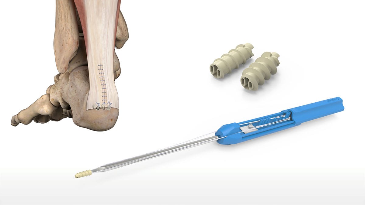 The Versatility of Suture Anchors in Orthopedic Repair iData Research