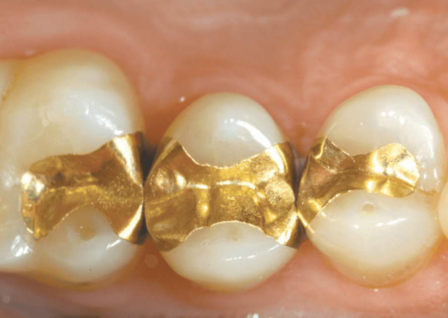 Gold Restorations - Ideal Dentistry