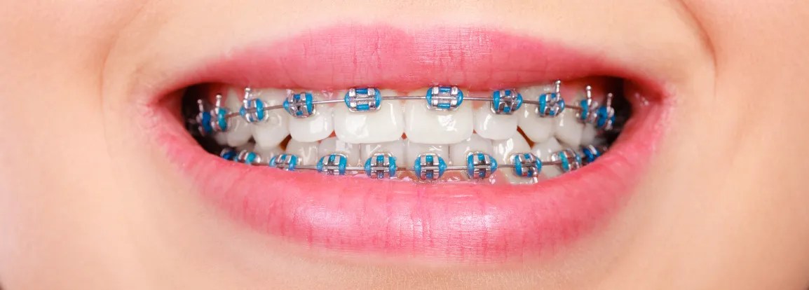 Guide To Braces In Singapore: Pros And Cons, Care Tips & Faqs