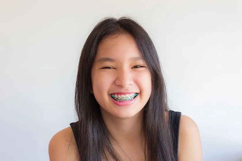 Braces In Singapore: Prices And Student Packages | I.dental