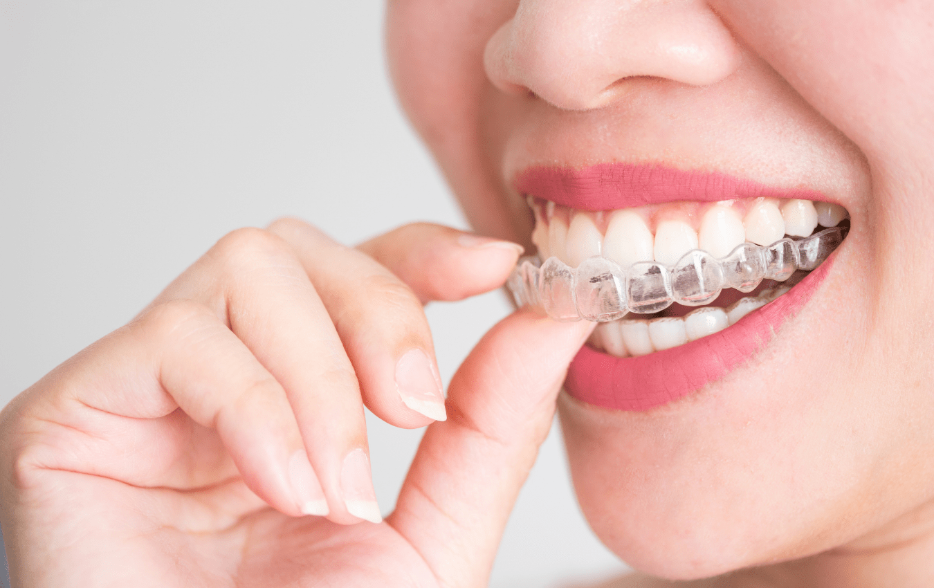 Comparison 7 Brands of Clear Aligners in Singapore [+Costs]