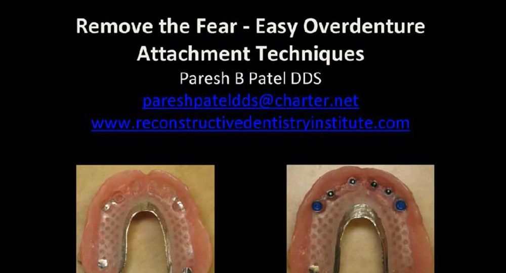 Remove the Fear Easy Overdenture Attachment Techniques iDental.Study