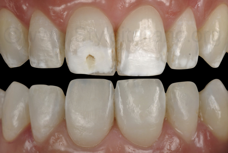 Treatment of extensive white spots by resin infiltration iDental.Study
