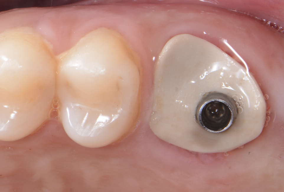 Sealing Socket Abutment a novel digitalized strategy for immediate implant placement in molar