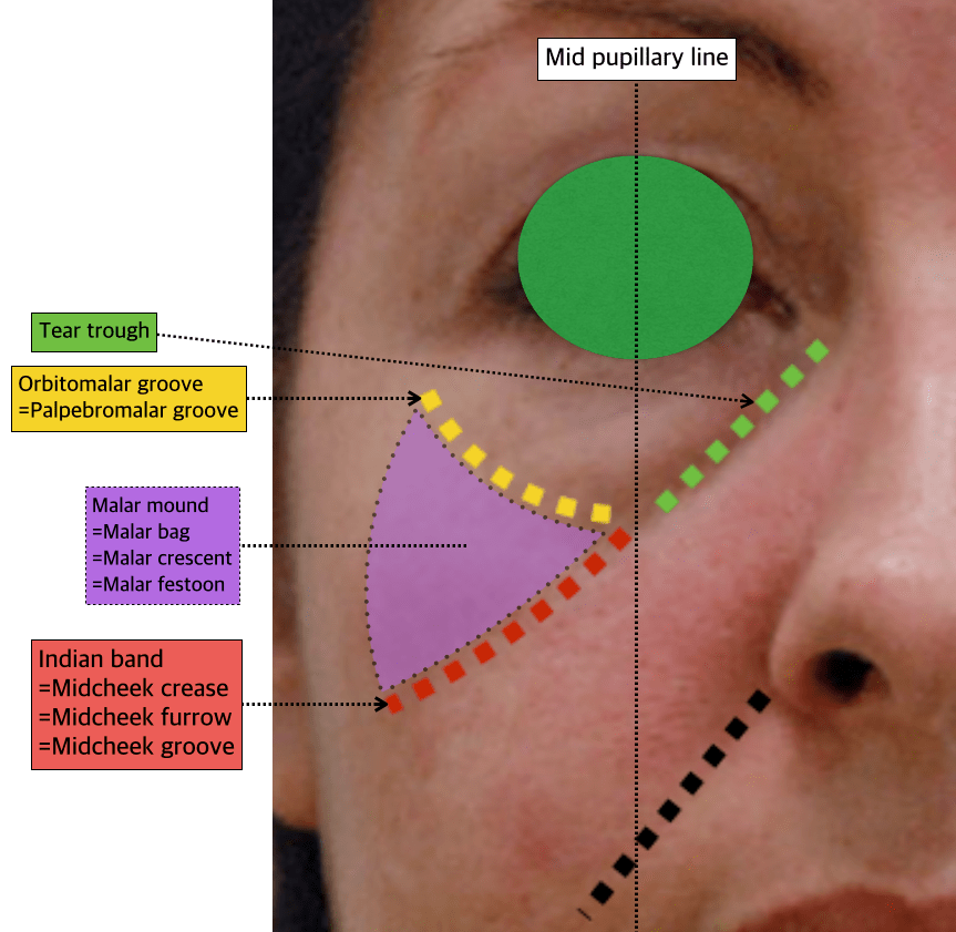 61. Mid face Indian bands D&PS