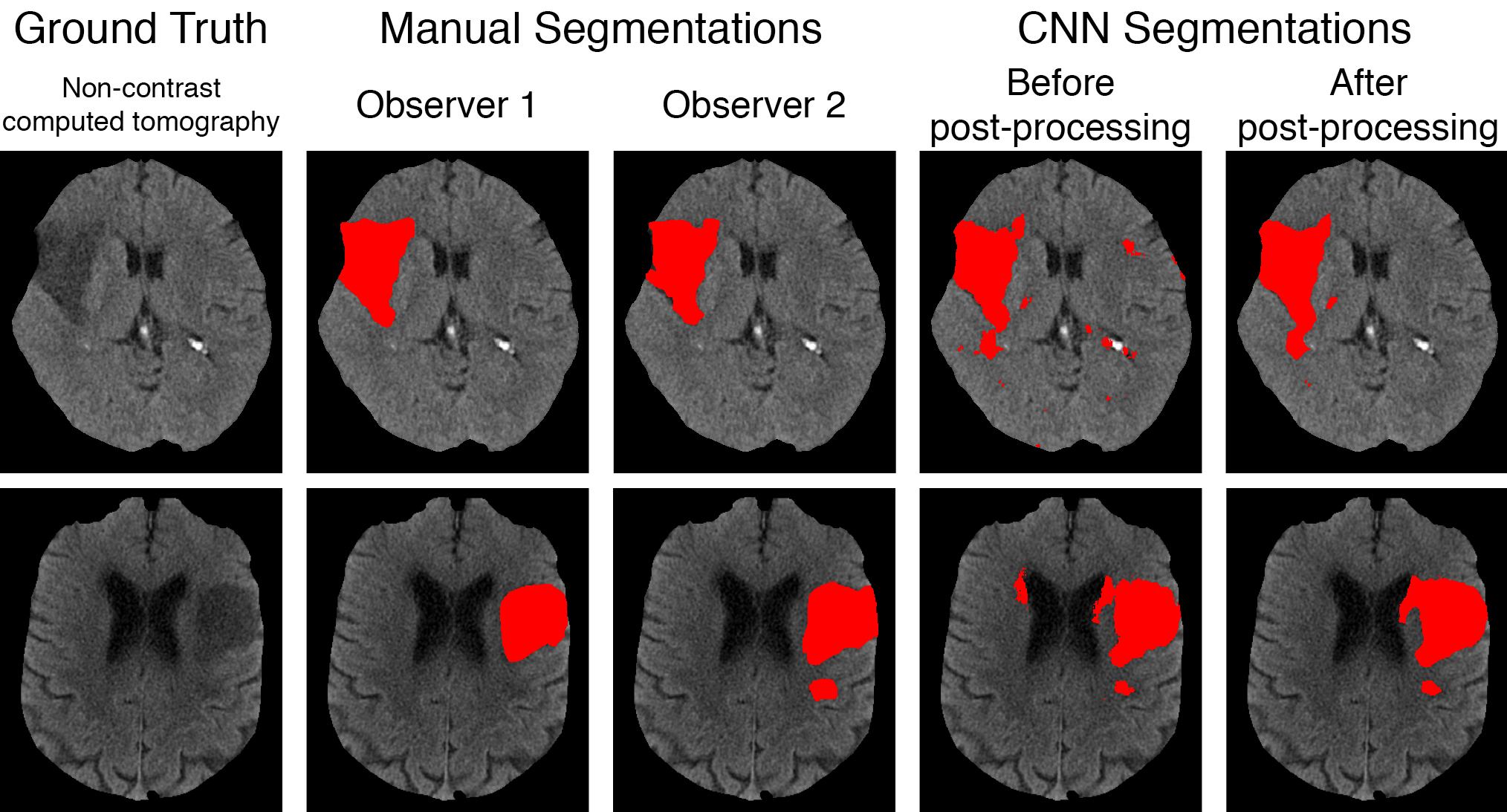 Automatic Segmentation of Stroke Lesions in Noncontrast Computed
