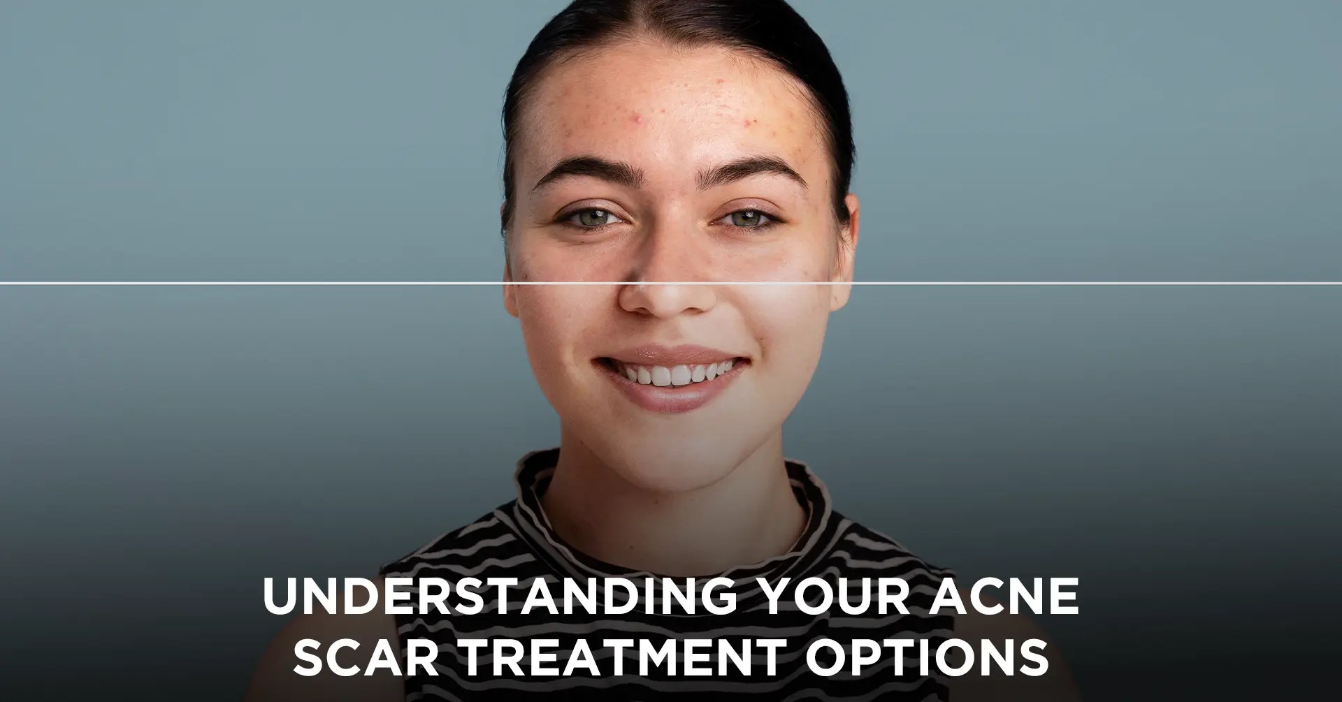 Understanding Your Acne Scar Treatment Options IEMLabs Blog