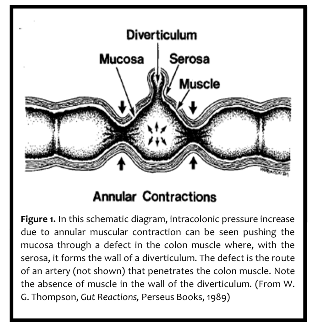 Diverticulosis and Diverticulitis IFFGD