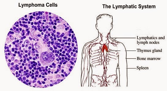 Hodgkin’s And NonHodgkin’s Lymphomas Health And Medical Information