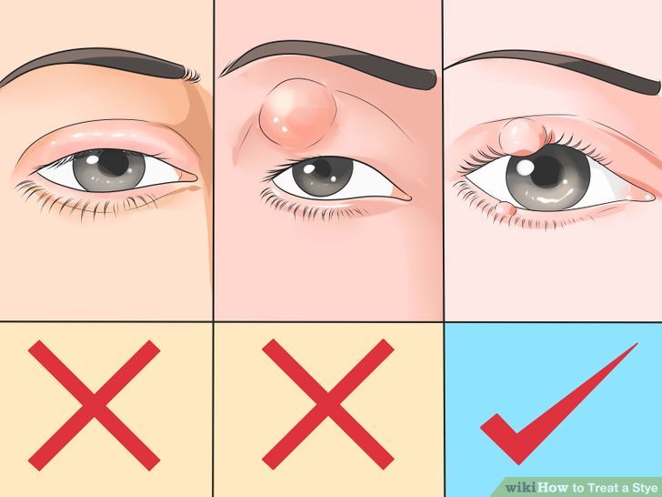 How to Treat a Stye Teachpedia