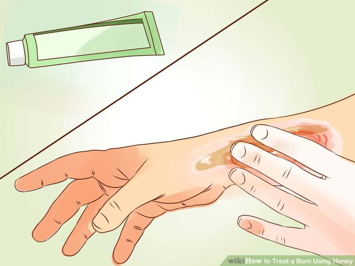 be more attractive How to Treat a Burn Using Honey