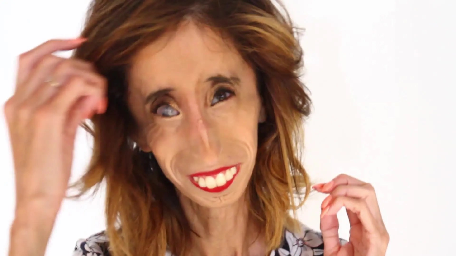 TIL of a woman, Lizzie Velasquez, who was born with a rare