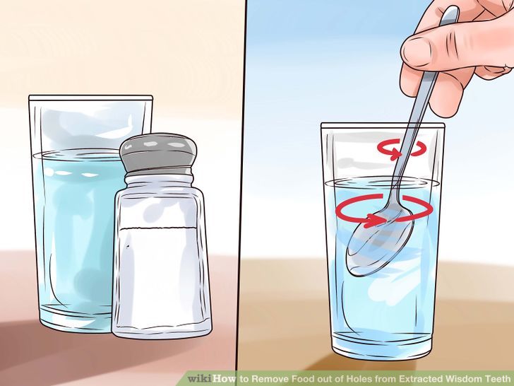 How to Remove Food from Extracted Wisdom Teeth Sockets Teachpedia
