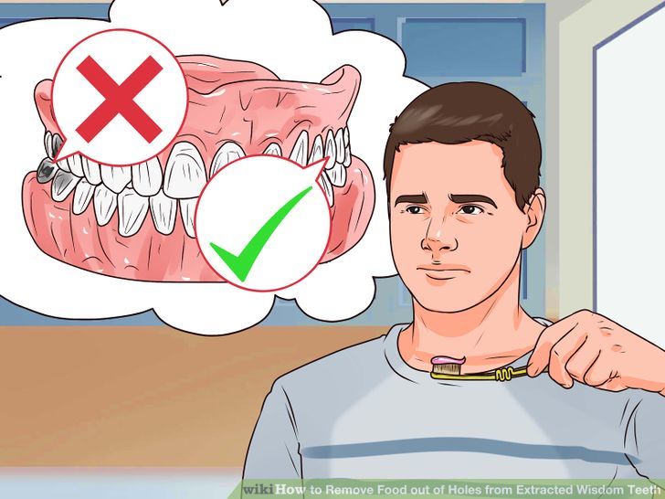 How to Remove Food from Extracted Wisdom Teeth Sockets Teachpedia