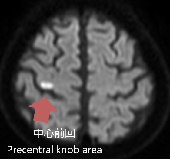 上肢単独麻痺を呈する脳血管障害│医學事始 いがくことはじめ