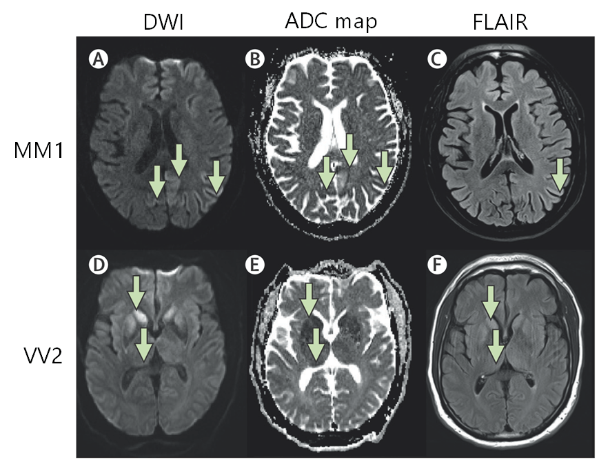 CJD CreutzfeldtJakob disease クロイツフェルト・ヤコブ病│医學事始 いがくことはじめ