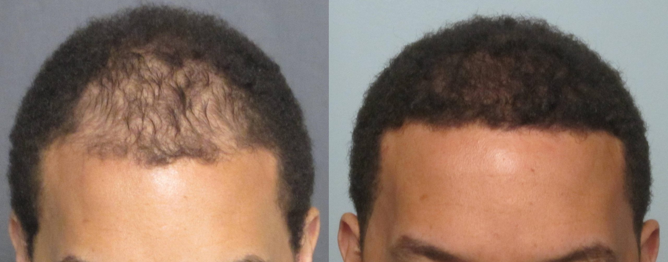 Men's Hair Transplant Before & After Pictures Dr. Sean Behnam MD