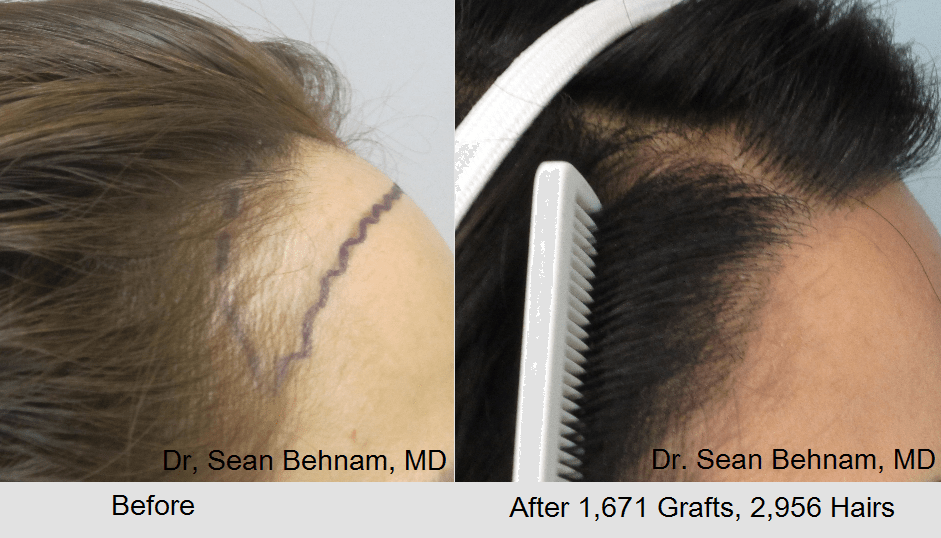 Women's hair transplant in Los Angeles
