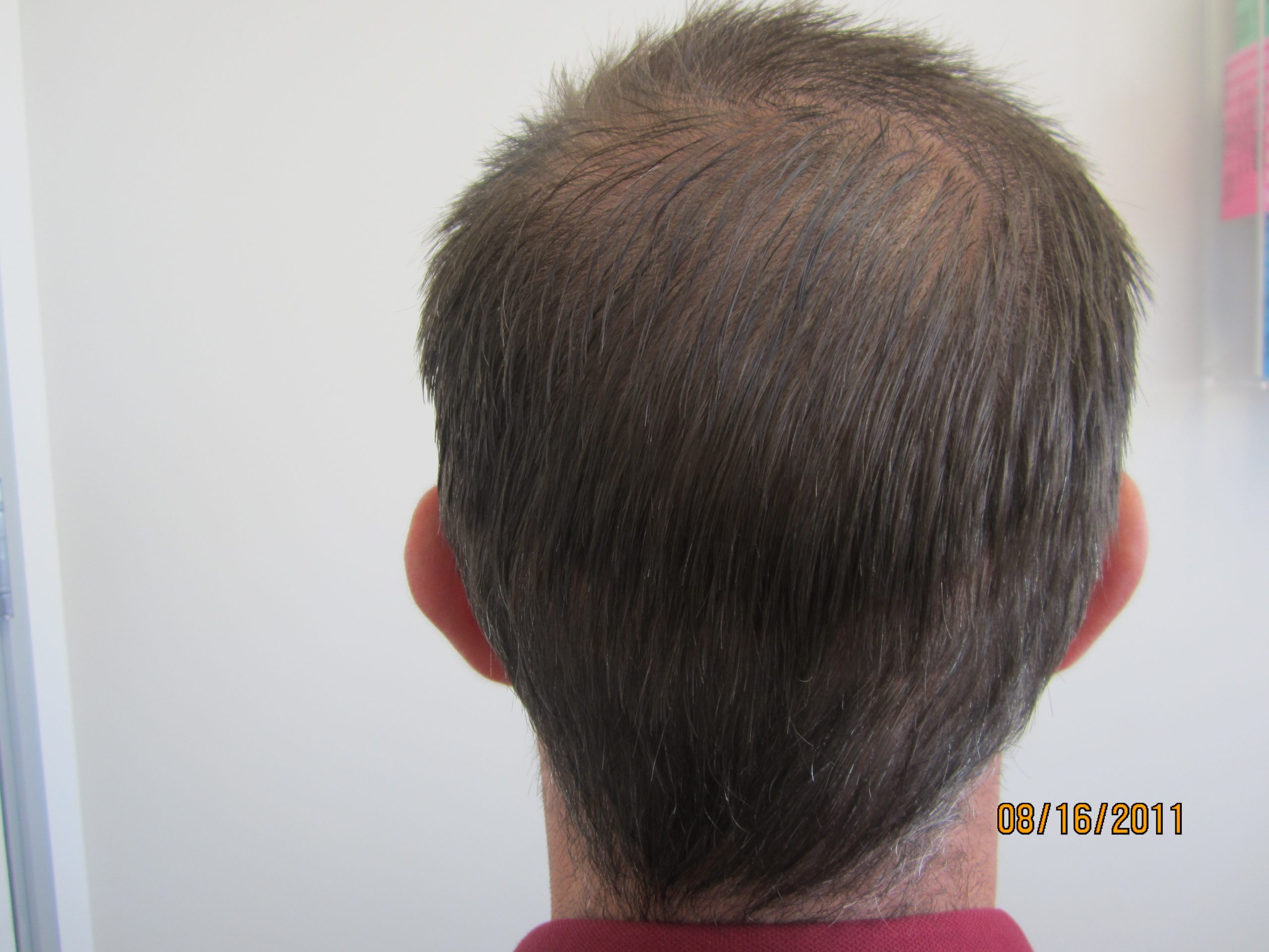 Back of scalp 2 days after strip hair transplant