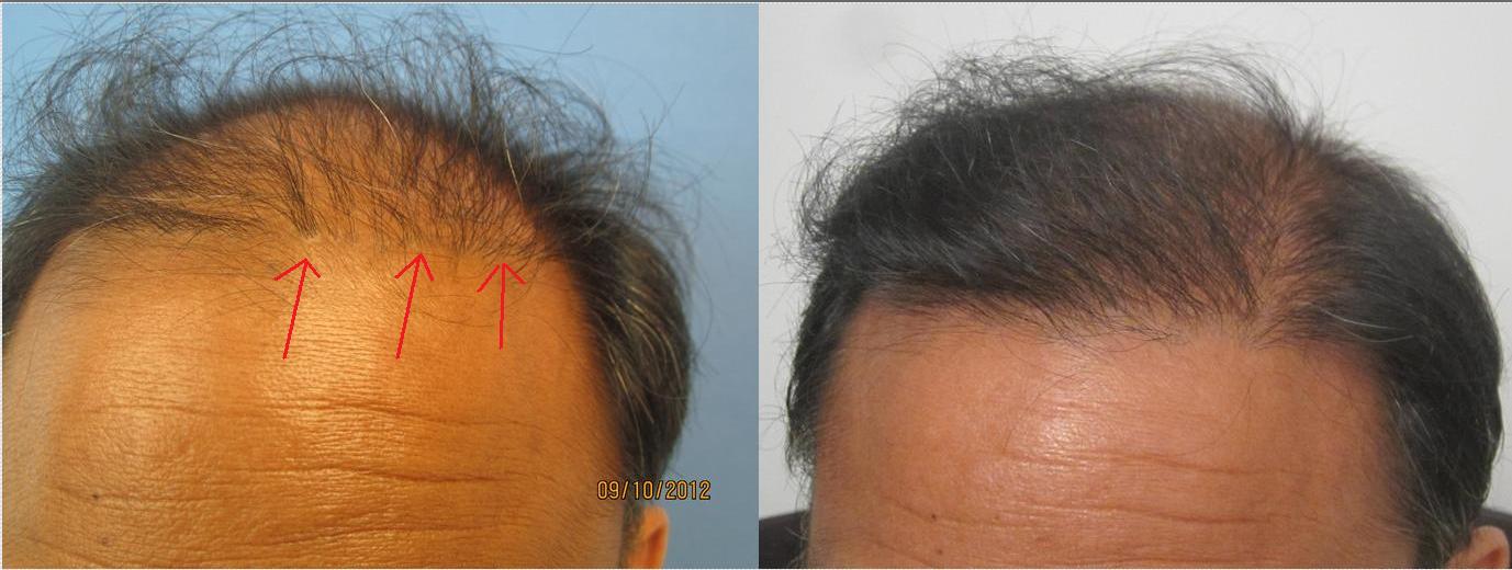 pluggy Hair Transplant