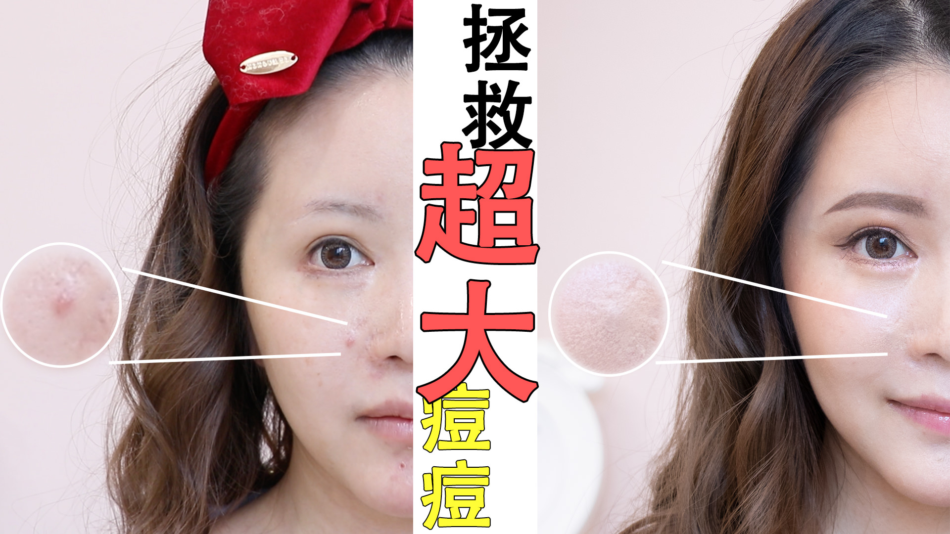 [YOUTUBE] 快速遮瑕凸起来的立体火山爆发痘 持妆一整天！