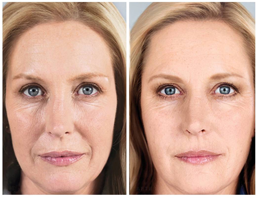 Sculptra Treatments in Dallas at Advanced Skin Fitness Medspa