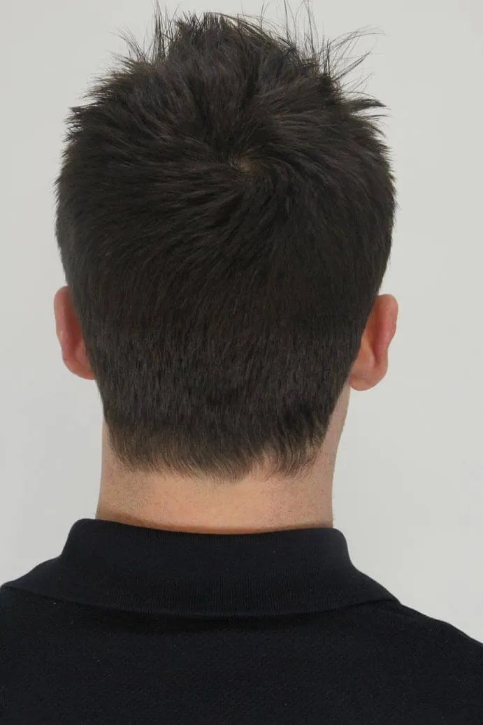 Best treatment for thinning crown and receding hairline Best treatment for thinning crown and receding hairline