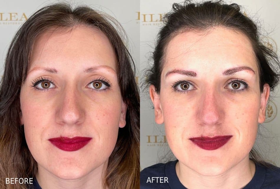 Eyebrow Transplant Houston TX Brow Restoration