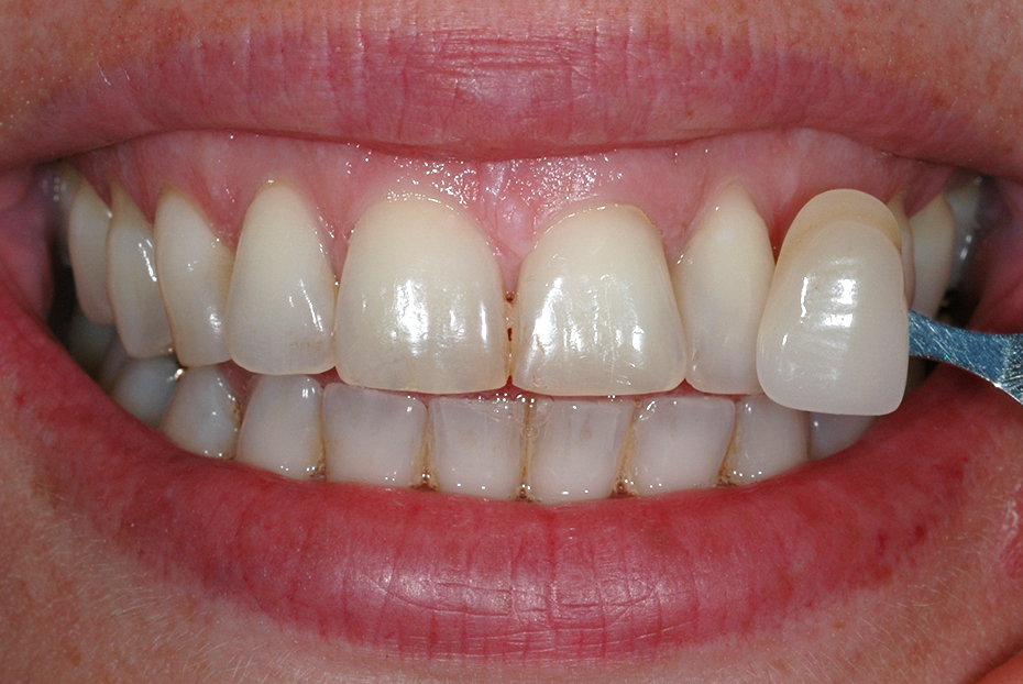 Other Treatments ILFORD Dental Centre