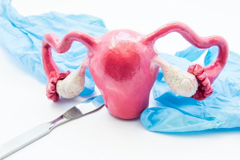 Oophorectomy Overview, Causes, Symptoms, Treatment
