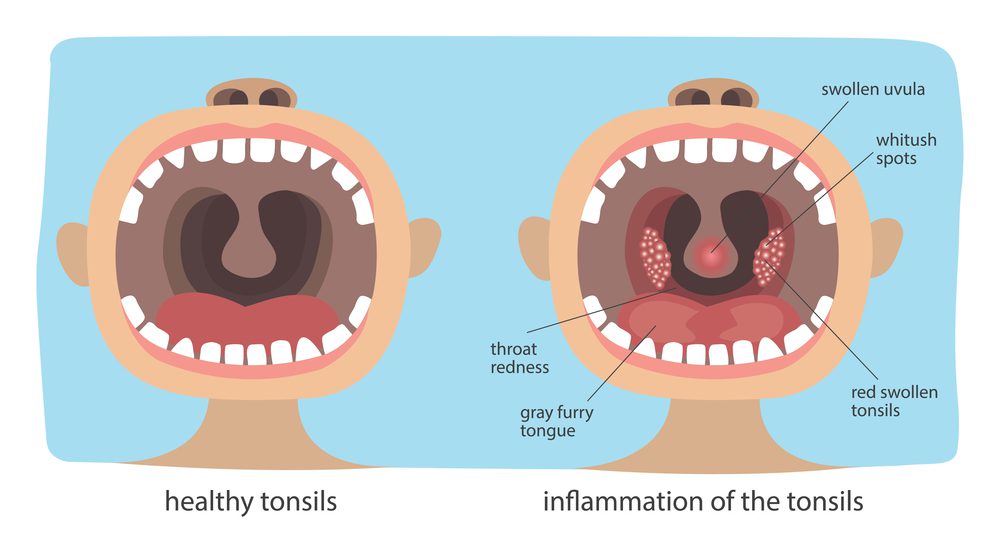 Sore Throat Tonsillitis Overview, Causes, Symptoms, Treatment