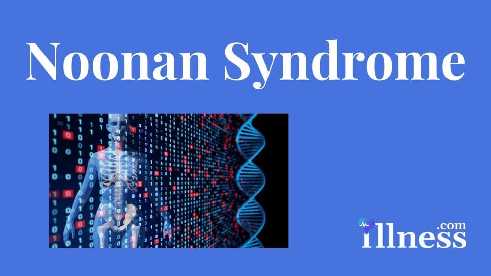 Noonan Syndrome Overview, Causes, Symptoms, Treatment