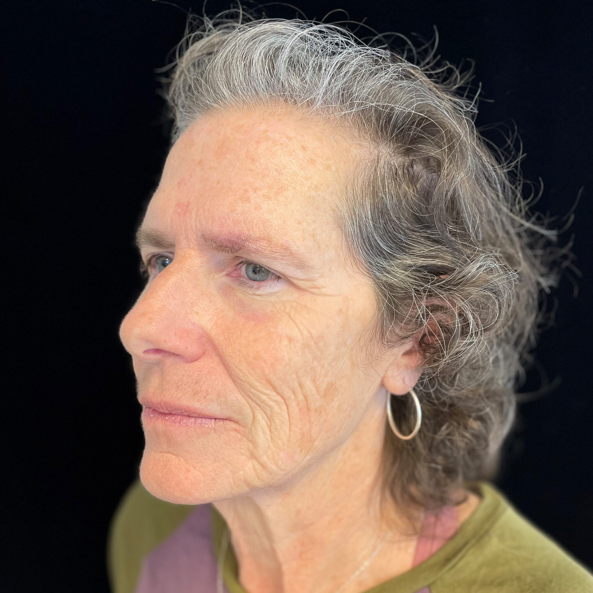 Laser Treatments | illuma Advanced Aesthetics • Centennial, CO