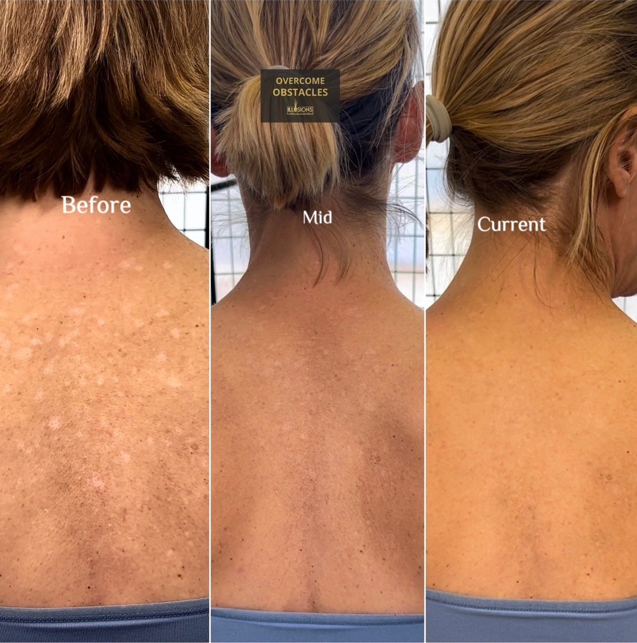 Paramedical Tattoos Dallas Illusions By Ink Studio