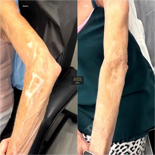 Paramedical Tattoos Dallas Illusions By Ink Studio