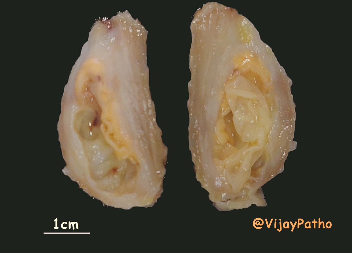 PATHOLOGY OF CYSTICERCOSIS Pathology Made Simple